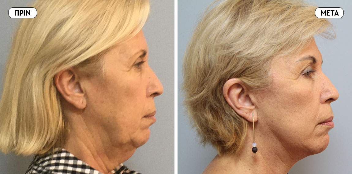 Face lifting