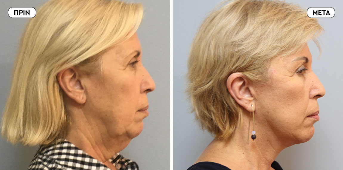 Face lifting