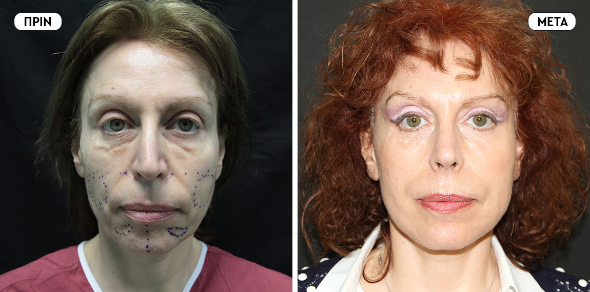 Face lifting