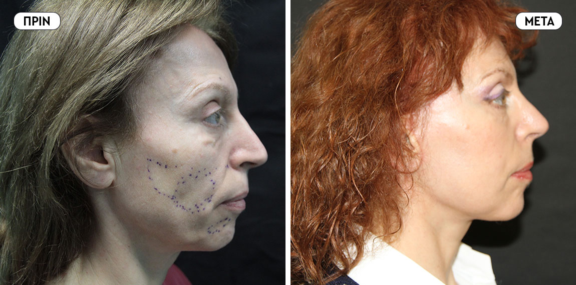 Face lifting