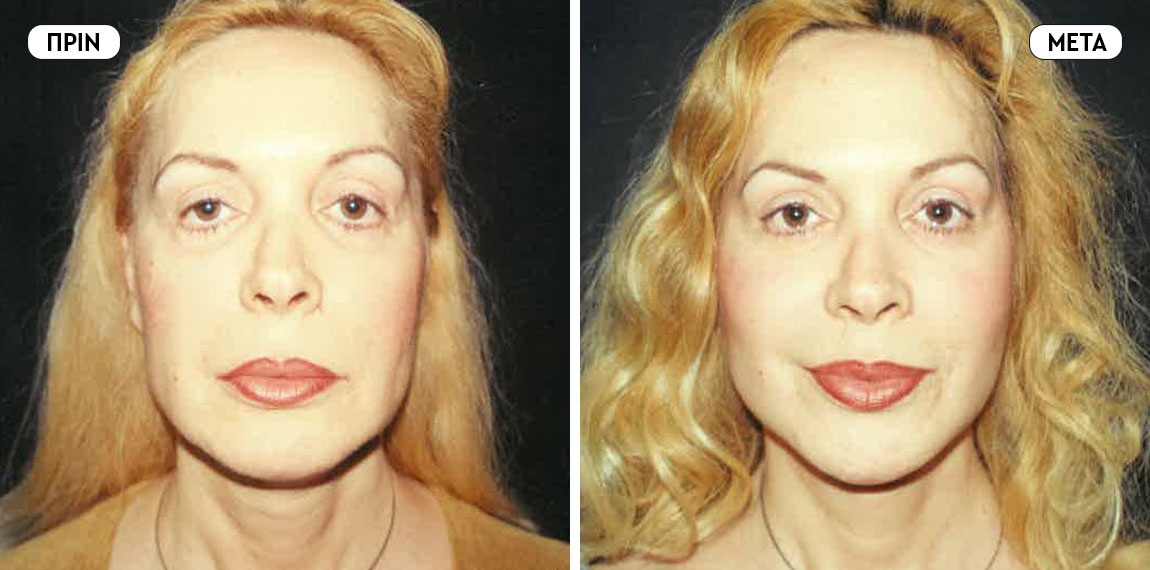 Face lifting