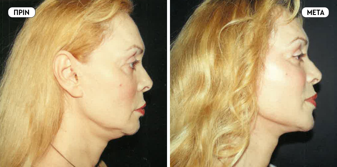Face lifting