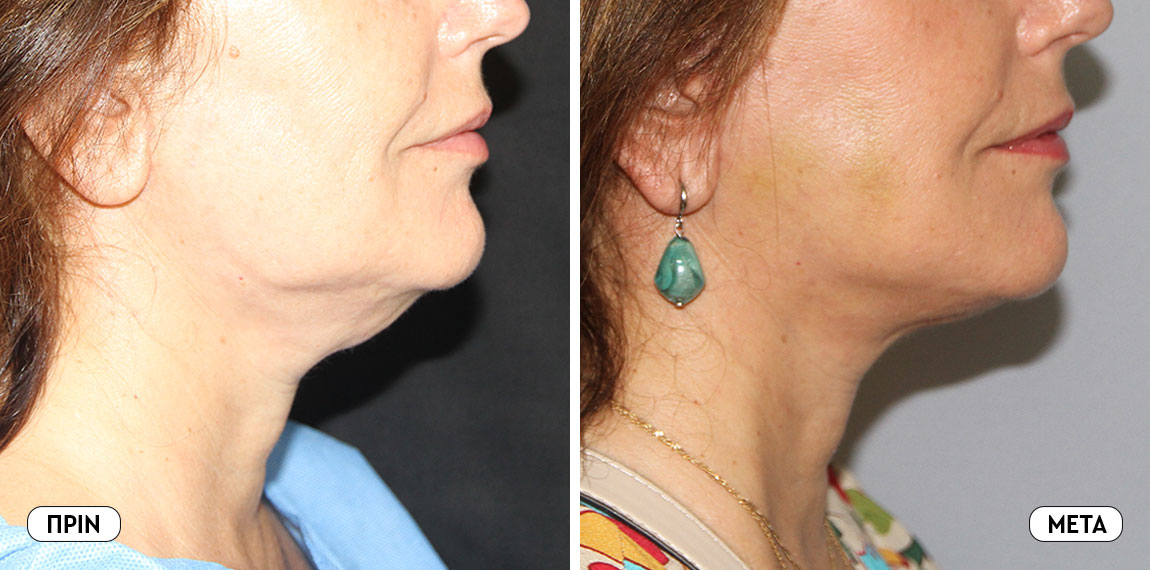 Face lifting
