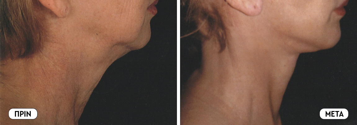 Face lifting